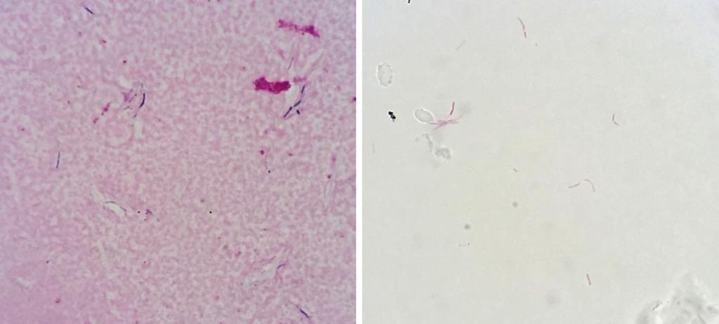 A 1,000 B 1,000 Figure. A: Gram staining of colonies revealing Gram-positive bacilli of moderate length ( 1,000). B: Ziehl-Neelsen staining of colonies revealing red bacilli ( 1,000).