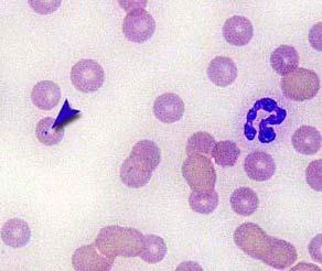 The anemia is hypochromic because the reticulocytes have not yet formed their adult concentrations of hemoglobin.