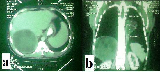 Fig. 2: (a) CT abdomen showing lesion in right lobe of liver (b) CT chest showing lesion in left lung (Source: Department of Radiology, NSCBSMC, Meerut) The cyst contents removed was sent to the
