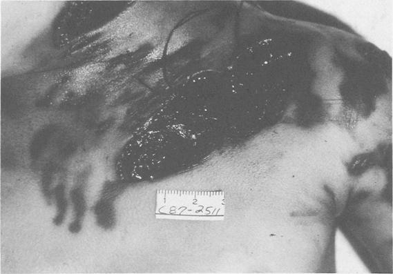 CLARK ET AL. 9 FATAL AND NEAR-FATAL ANIMAL BITE INJURIES 1259 FIG. 4--The victim in Case 2. The fatal wound in the left side of the neck (with suture in place) is illustrated.