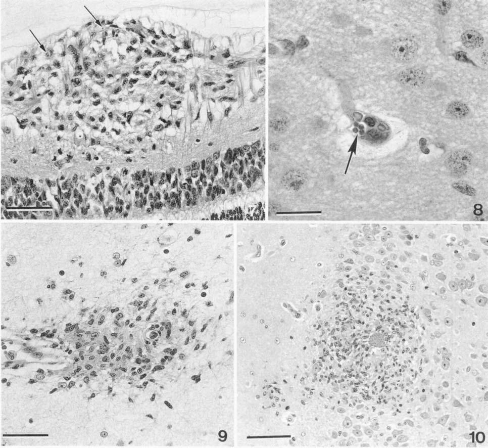 Vet Pathol 33:3, 1996 Neonatal Toxoplasmosis in Cats 293 Fig. 7. Eye, retina; kitten No. 15. A nodular aggregate of macrophages and neutrophils expands the inner retina.