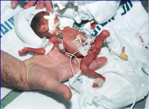 A premature infant with an infection AL is 26w, 890 gm neonate 2 courses of antibiotics D1 ampicillin and gentamicin (RD)
