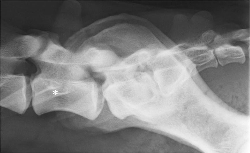 Lappalainen et al. Acta Veterinaria Scandinavica 2012, 54:27 Page 5 of 10 Figure 6 A laterolateral radiograph of lumbosacral area of a German shepherd dog with a lumbosacral transitional vertebra.