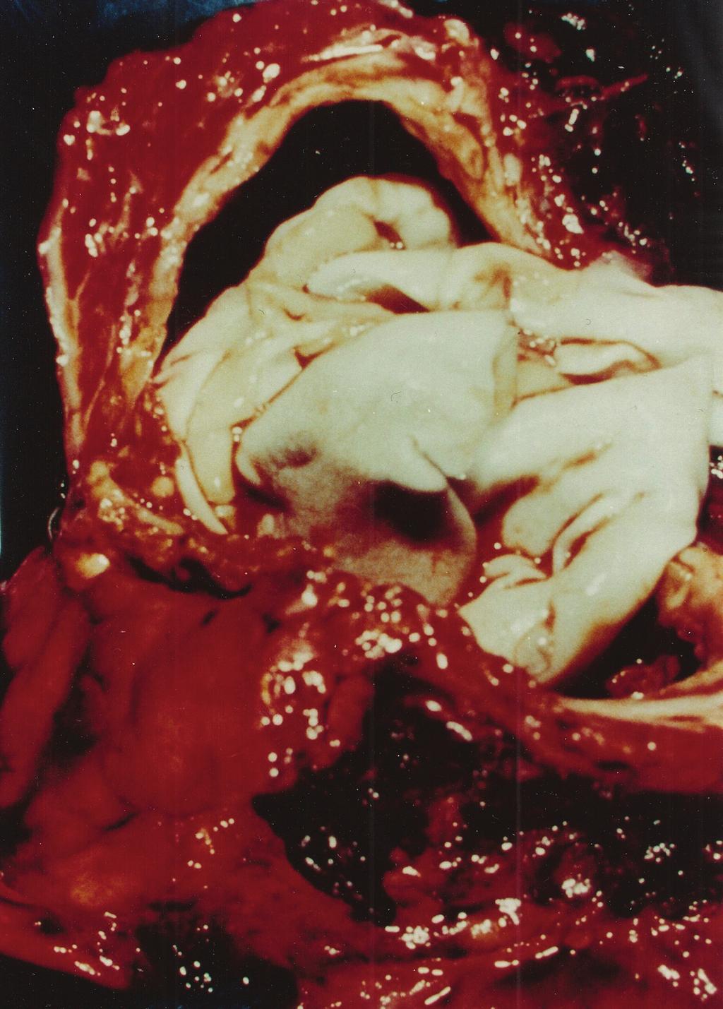 The cyst consisted of an outer shell, the ectocyst, with a glistening white inner surface. Contained within was a pearly membranous structure, the endocyst, lying in a pool of turbid brownish fluid.