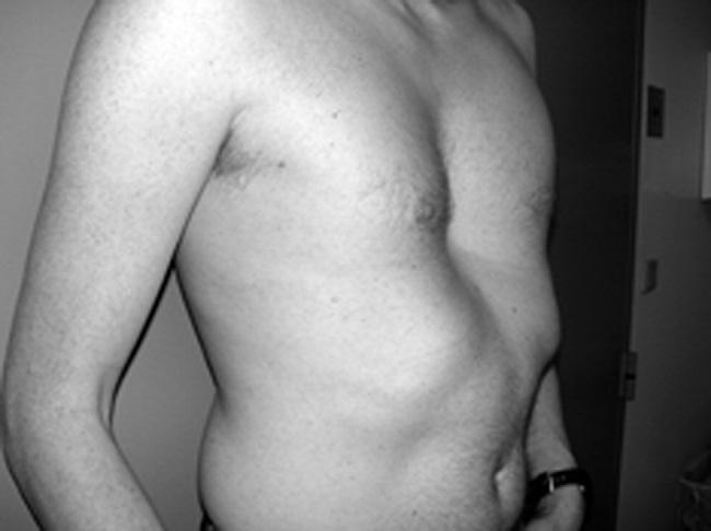 Ann Thorac Surg PILEGAARD AND LICHT 2008;86:952 7 PECTUS EXCAVATUM IN ADULTS 953 Fig 1. A typical case of pectus excavatum in an adult before minimally invasive correction. Fig 2.