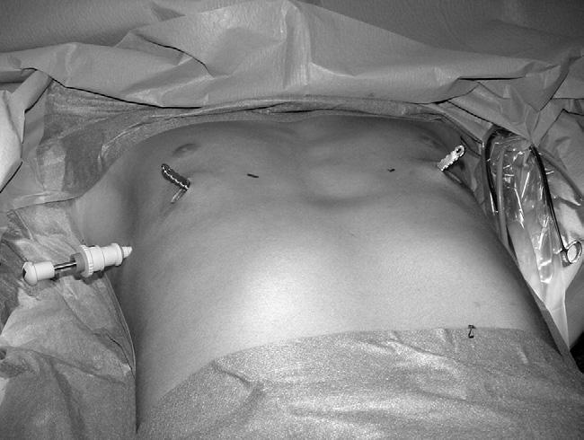954 PILEGAARD AND LICHT Ann Thorac Surg PECTUS EXCAVATUM IN ADULTS 2008;86:952 7 Fig 4. Same patient as Figure 2 just before the metal pectus bar is turned.