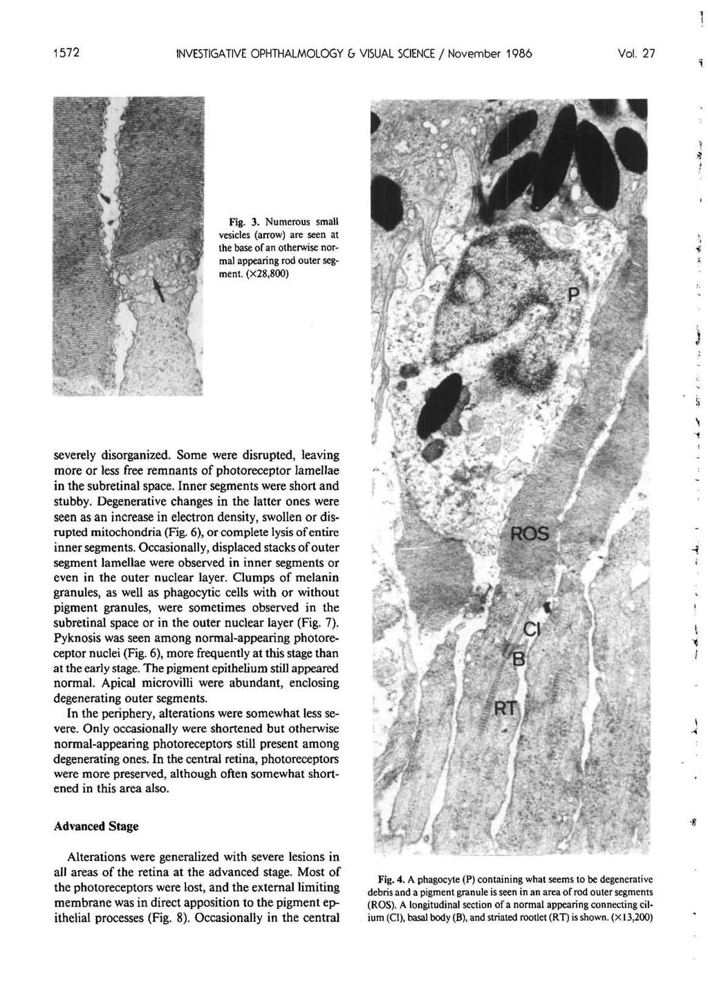 1572 INVESTIGATIVE OPHTHALMOLOGY & VISUAL SCIENCE / November 1986 Vol. 27 Fig. 3. Numerous small vesicles (arrow) are seen at the base of an otherwise normal appearing rod outer segment.