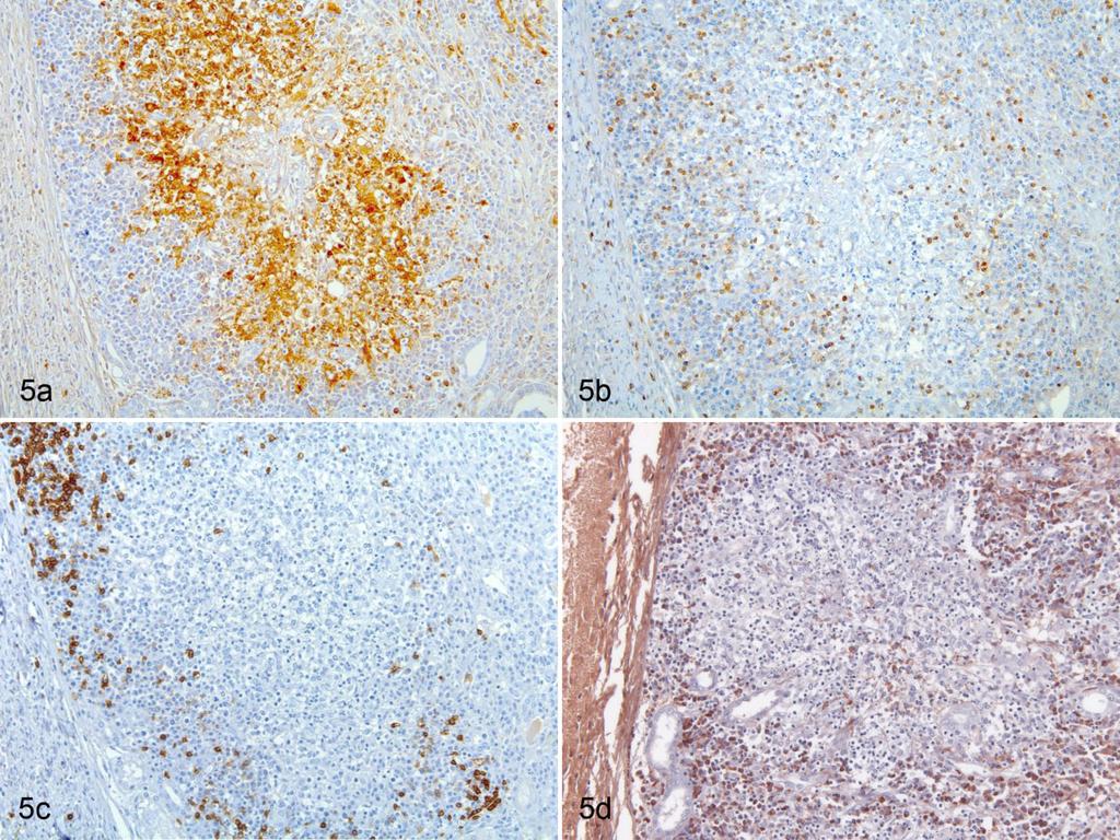 Doria-Torra et al 1183 Figure 5. Granuloma without necrosis, kidney, ferret. Figure 5a. IHC for lysozyme shows large amount of macrophages and scant neutrophils in the center of the lesion. Figure 5b.