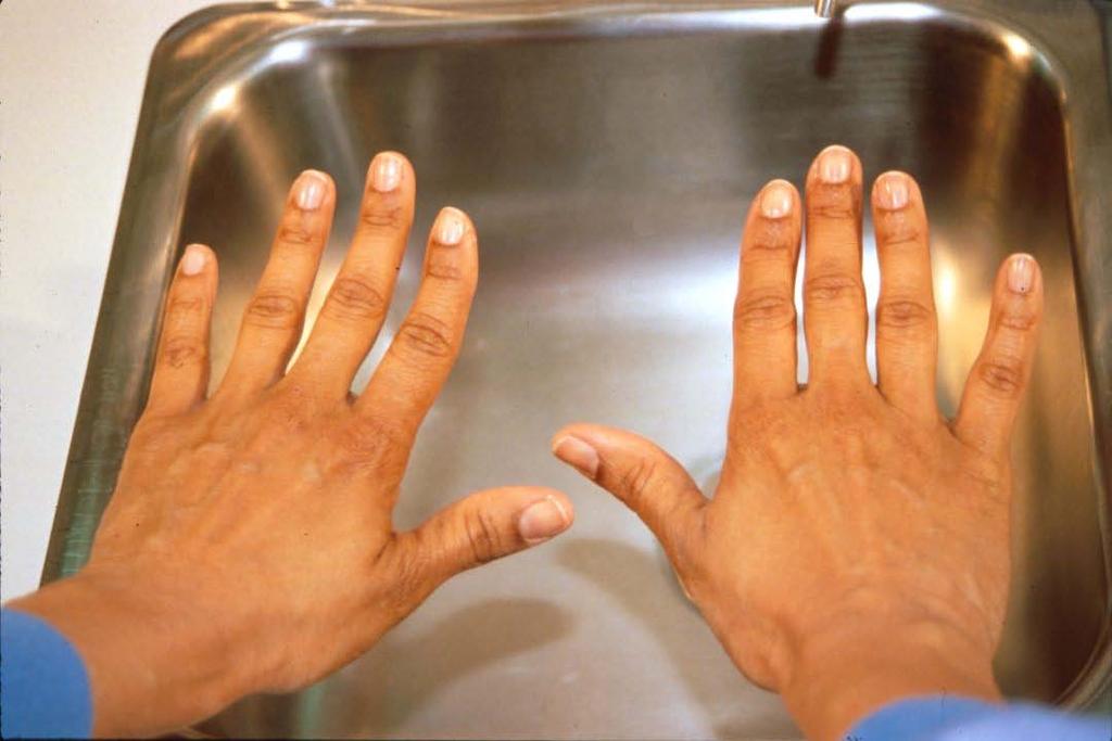 Hand Antisepsis Protocol 6. The area under the nail is a common area for dirt, secretions and associated microorganisms.