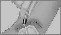 - Simple - Reduce needlestick