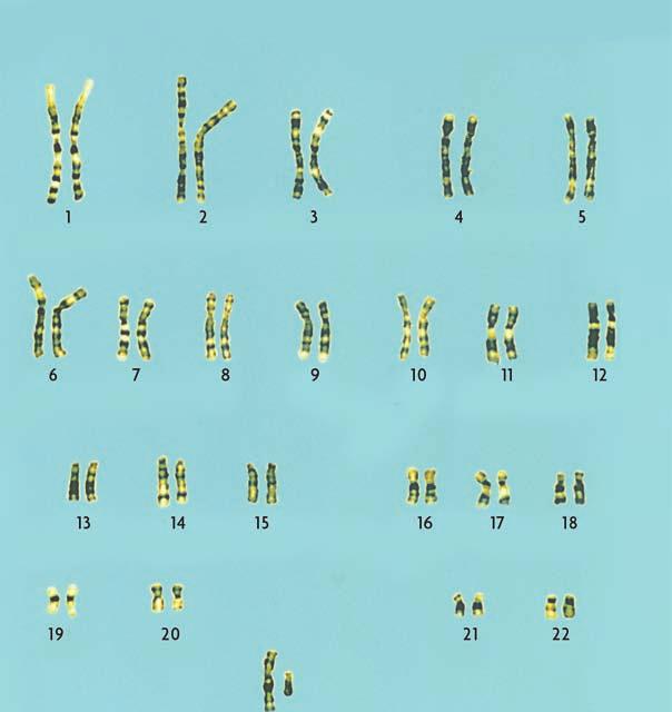 Chromosome changes can be dramatic, such as when a person has too many chromosomes. In Down syndrome, for example, a person has an extra copy of at least part of chromosome 21.