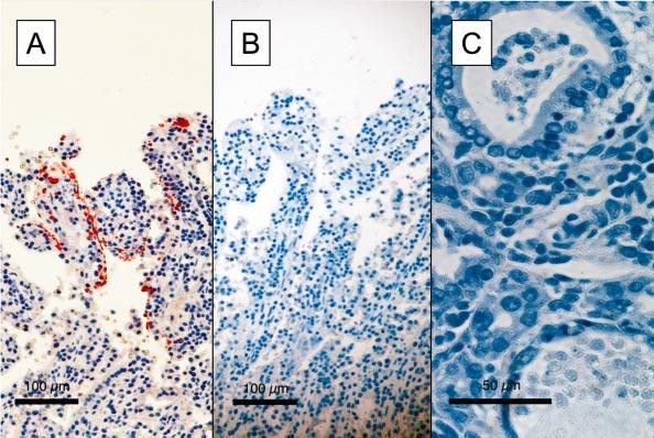 612 Brief Communications Figure 1. Photomicrographs of the small intestine from case 1. A, Immunohistochemistry staining with murine anticoronavirus antibody. B, Negative isotype control sections.