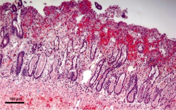 The histologic lesions were interpreted as severe necrotizing enteritis with diffuse lymphoid depletion, most consistent with a viral etiology and possibly secondary bacterial septicemia.