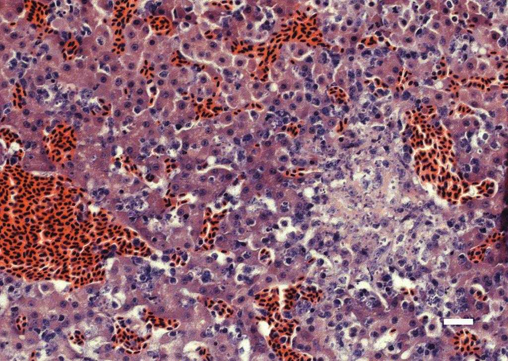 scattered foci of necrosis with rare macrophages, plasma cells and lymphocytes (Figure 3).