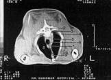 Fig. 4. C.T. slice N o 12 through the 4 th thoracic vertebra.