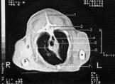 8 lung; 9 thymus; 10 sternum. Fig. 9. C.T. slice N o 17 through the 1 st lumbar vertebra.
