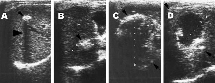 RESEARCH Figure 3. Lesions of alveolar echinococcosis (AE) by abdominal ultrasound examination. A) Calcified lesion: hyperechoic structure with a typical posterior shadow.