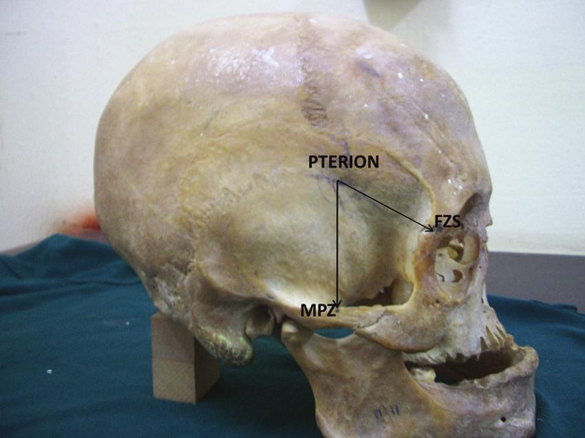 2 ISRN Anatomy Table 1: Comparison of the measurement of the distance of the pterion from the midpoint of zygomatic arch (MPZ) and the frontozygomatic suture (FZS) between sexes and sides.