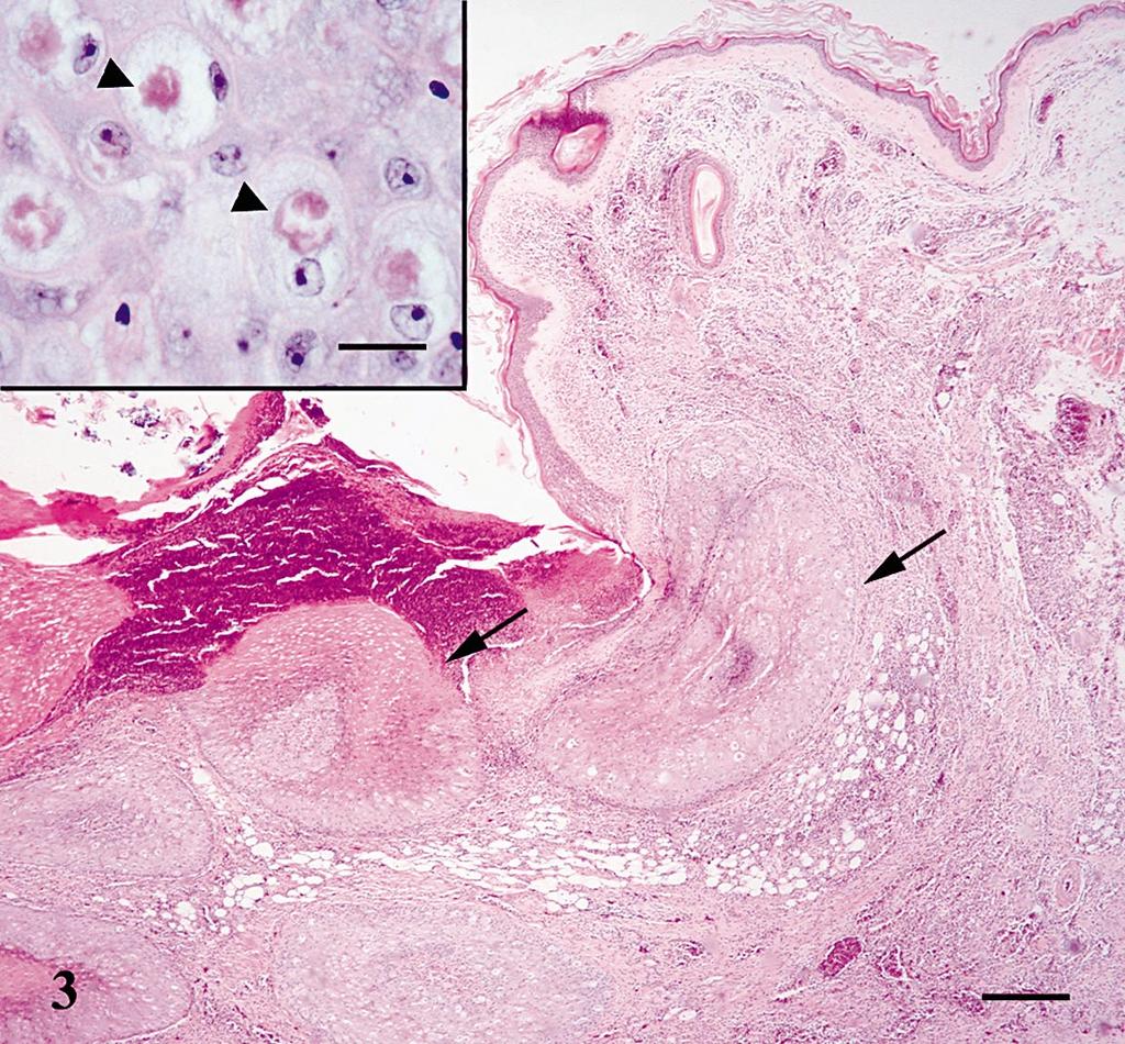 SHORT COMMUNICATIONS 353 FIGURE 3. Histologic section showing ulceration and necrosis of the epidermis with superficial crusting formation and dermal inflammatory infiltrate.
