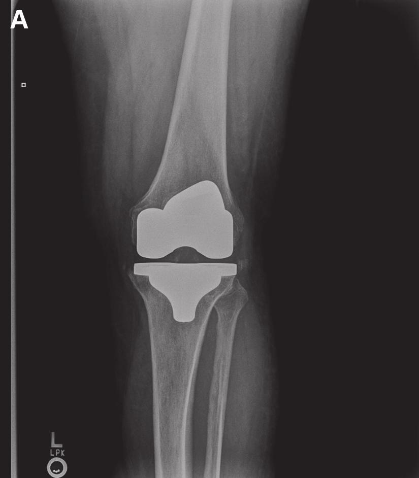 2 Case Reports in Orthopedics (a) (b) Figure 1: Anterior-posterior (a) and lateral (b) radiographs of left primary total knee arthroplasty from initial clinic presentation.