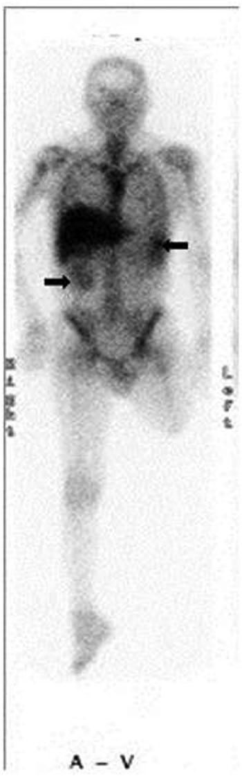 4 SAGE Open Medical Case Reports Figure 4. Gallium-67 scintigraphy revealed accumulation in the spleen and right kidney.