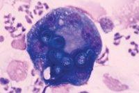 Figure 5. Blastomyces organisms have been phagocytosed by macrophages in this transtracheal wash sample from a dog with pulmonary blastomycosis.