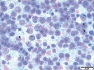 precursors (1), metarubricytes (2) and nu cle a ted red blood cells (3) (Mo di fied Wright stain objective 100x). Figure 2. Microphotograph of bone marrow.