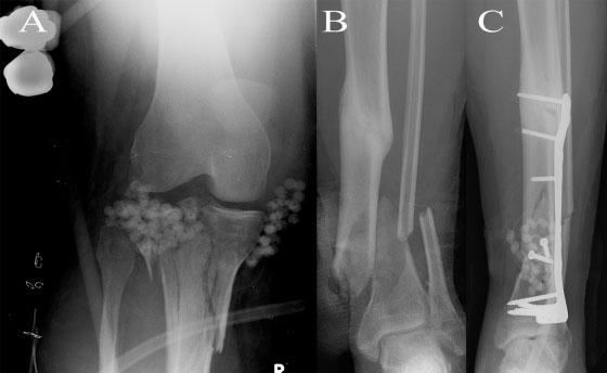 102 SEMINARS IN PLASTIC SURGERY/VOLUME 23, NUMBER 2 2009 Figure 1 Examples of use of PMMA antibiotic beads in open tibia fractures.