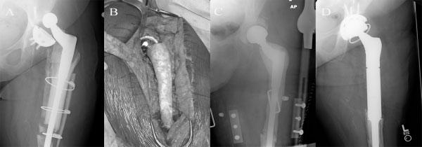 104 SEMINARS IN PLASTIC SURGERY/VOLUME 23, NUMBER 2 2009 Figure 2 Use of a temporary antibiotic-impregnated prosthesis in the treatment of an infected allograft prosthetic composite total hip