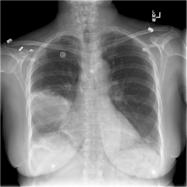 Case #3 74 yo female with DM, HTN, CAD, dementia, presents with 2 days of confusion, shortness of breath lethargy.