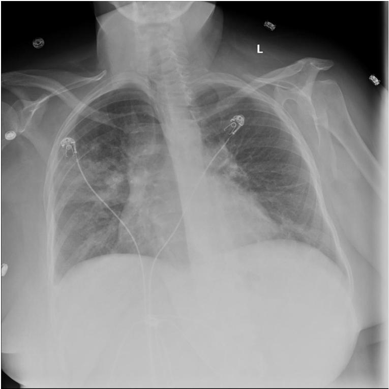 CASE #1 34 yo female with no pmhx 10 days of: runny nose Documented fevers L sided pleuritic chest