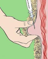 After administration the site should be gently massaged. Intramuscular injections Intramuscular injections are made into muscle.