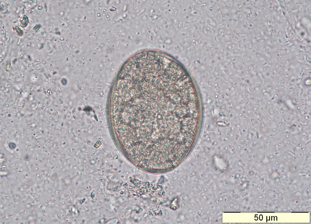 Diphyllobothrium latum Egg from the fish tapeworm in stool.