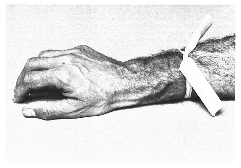 414 Davidson, Schafer and Jones Fig. 7. Penrose drain used as a constricting band to retard distal lymphatic and superficial venous flow.