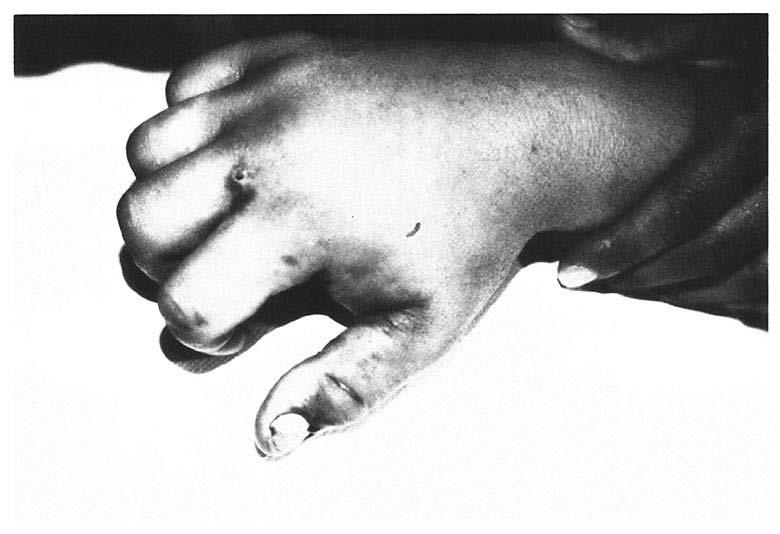 North American pit vipers 405 Fig. 6. Typical appearance of the hand shortly after envenomation by a rattlesnake. The bite occurred between the thumb and forefinger.