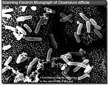 Pseudomembranous Colitis Clostridium difficile: toxin mediated disease Toxin A (major) Overproduction in outbreak strains of C. difficile due to deletion in tcdc gene.