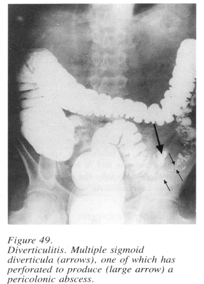 Case: ruptured appendix LF improved post-operatively and completed a 7 day course of oral cephalexin. 4 days after completing antibiotics she felt diffuse pain over the site of the appendectomy.