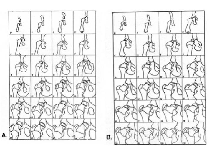 1985 and Healthbase 2017) Figure 3: A. Radiographic drawings from overlay tracings of normal hip growth and development from birth to one year old. B.