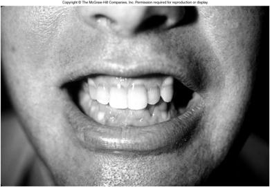 Tetracycline treatments can cause teeth discoloration.