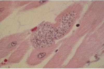 Topic-Chagas Disease (American Trypanosomiasis) Figure 3.