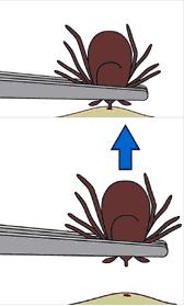 How to Remove a Tick Remove it as soon as possible.