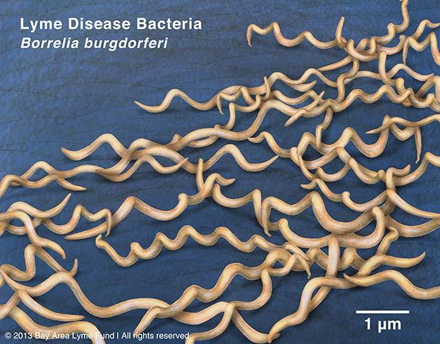 Lyme Disease Multi-systemic disease Caused by bacterium Borrelia burgdorferi Most widespread vector-borne disease in the USA 20,000-30,000 people diagnosed per year in