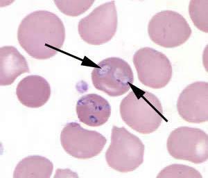 Babesiosis Protozoan - Babesia Black-legged/ Deer Tick Parasitize red blood cell More common in domesticated animal then humans Symptoms within 1-6