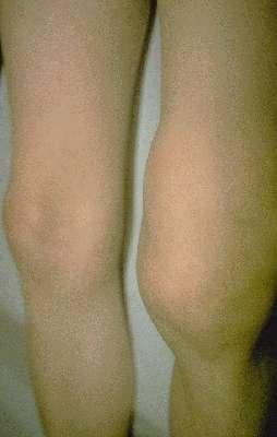 Lyme Arthritis Large joints, especially the knee