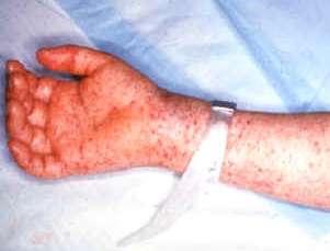 Rocky Mountain Spotted Fever (RMSF) Images: