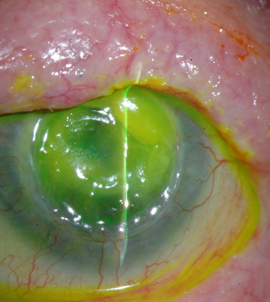 Generics 1999 ACSRS Survey Observations of corneal melting after routine anterior segment surgeries Topical generic