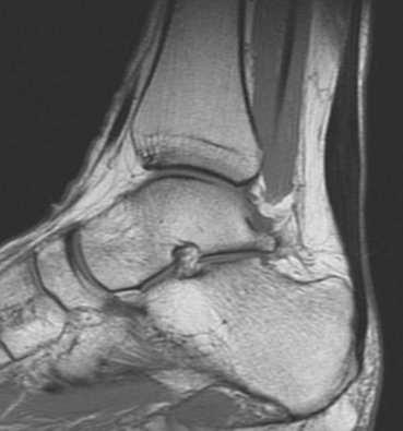 Fig 1: MRI scan of foot