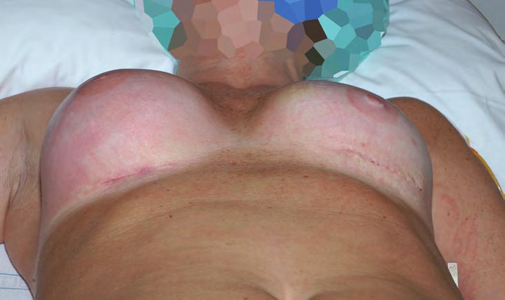 Case reports Patient 1 A 47-year-old patient underwent revision surgery due to asymmetry.