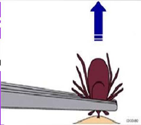 Prevention: Humans Tumble clothes in the dryer to kill remaining ticks (High heat) Remove any ticks using tweezers close to tick s mouth, gently with upward pull (no twisting)
