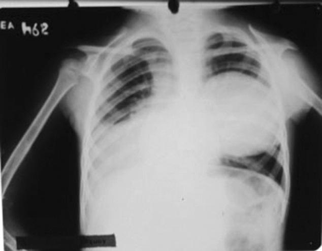 128 P. Moro, P.M. Schantz Figure 4 Chest radiograph of a 5-year old Peruvian girl with a hydatid cyst in the left lung field detected as part of an imaging survey in an endemic area.